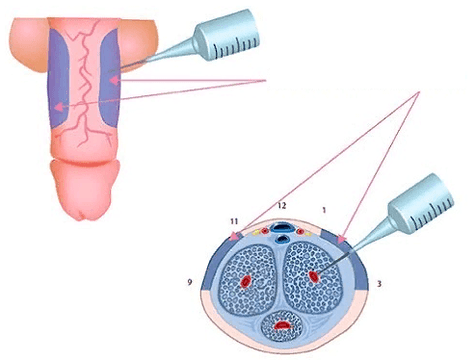 inxeccións para engrosar o pene