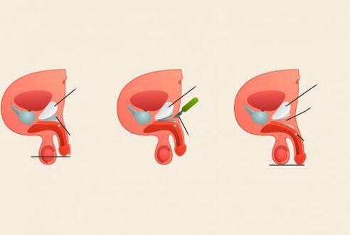 antes e despois da cirurxía de ampliación do pene
